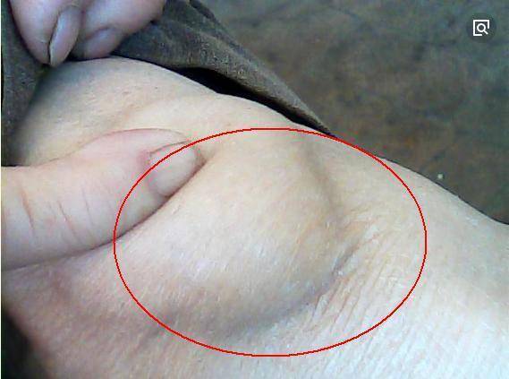 1,制动卧床休息这是急性期滑膜炎最常用的方法,一般是要把患肢用支架