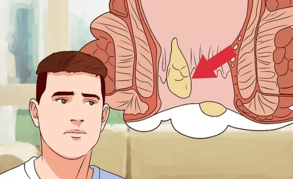 广东民安医院讲解好不好解决痔疮发作太痛了!痔疮到底是怎么长出来的?