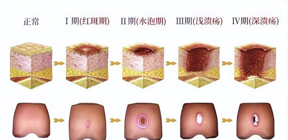 为何古代背上长个"痘痘"就得死人,"背疽"到底是一种什么疾病_朱元璋