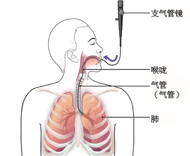 气管镜下的气管解剖图图片