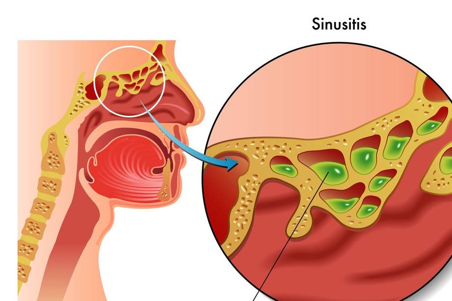 遥望鼻涕挂前川,别把鼻窦炎当鼻炎,慢性鼻窦炎要如何治疗_患者_症状