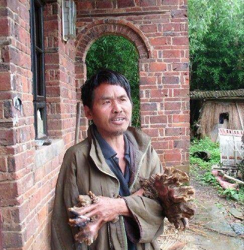 湖南"树人"刘忠文:四肢与树皮无异,采用偏方导致双手