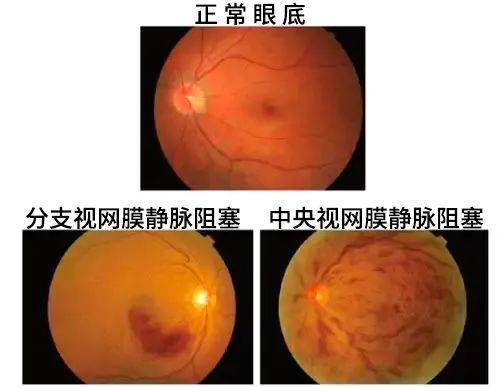 兰州爱尔眼科医院丨陈雪艺院长 一张眼底照片藏着多少秘密(图5)