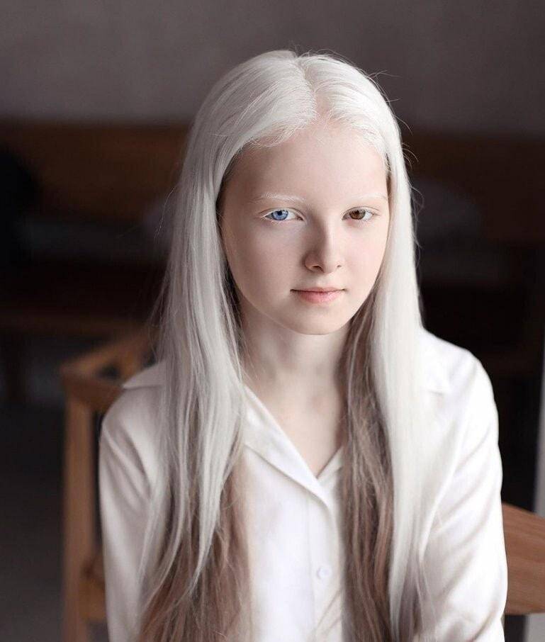 现实版的唐僧肉:非洲白化病人被当神药贩卖,其血液比黄金还要贵_疾病