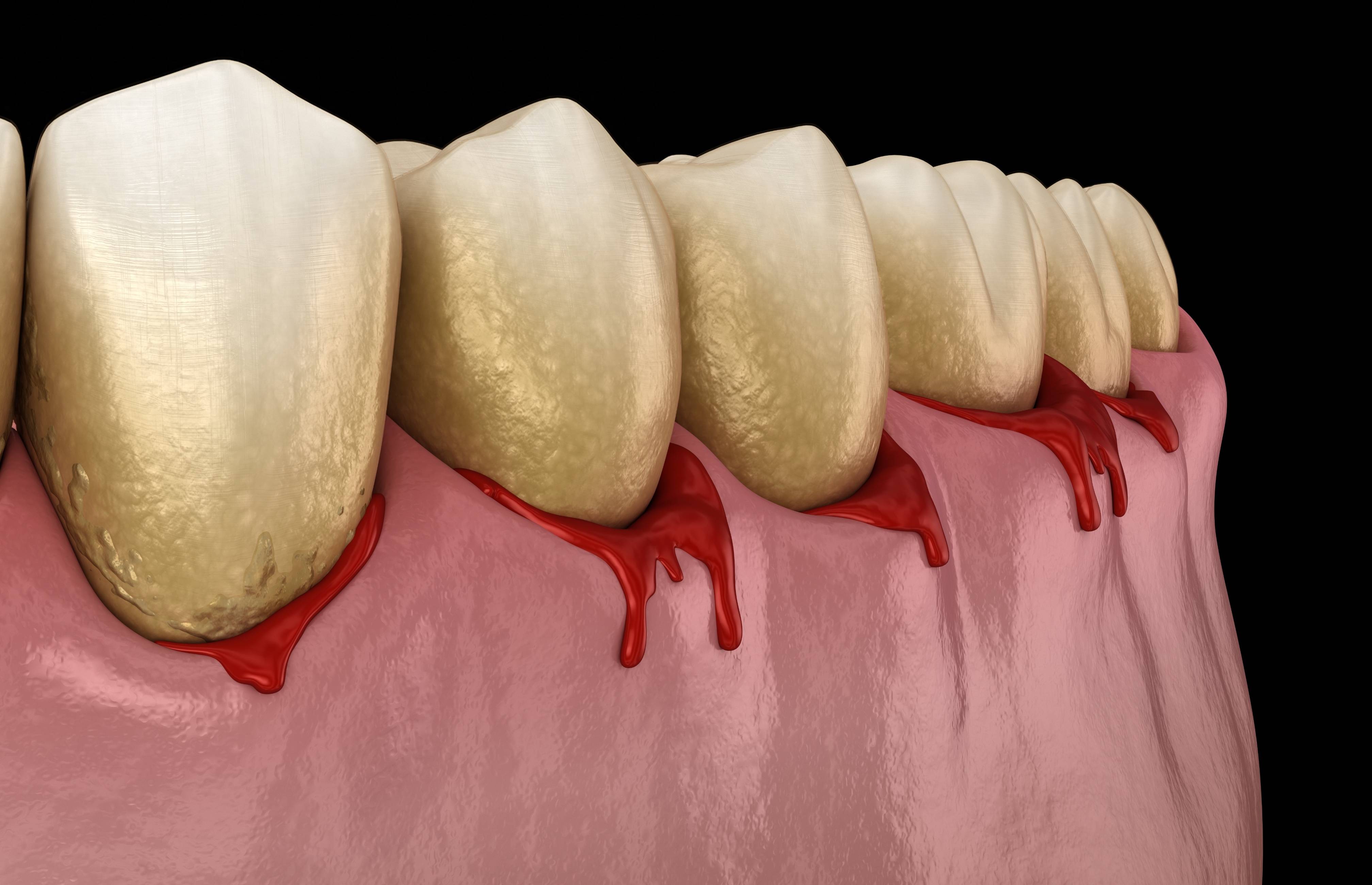壹邦健康知识:牙龈癌的发病原因是什么?