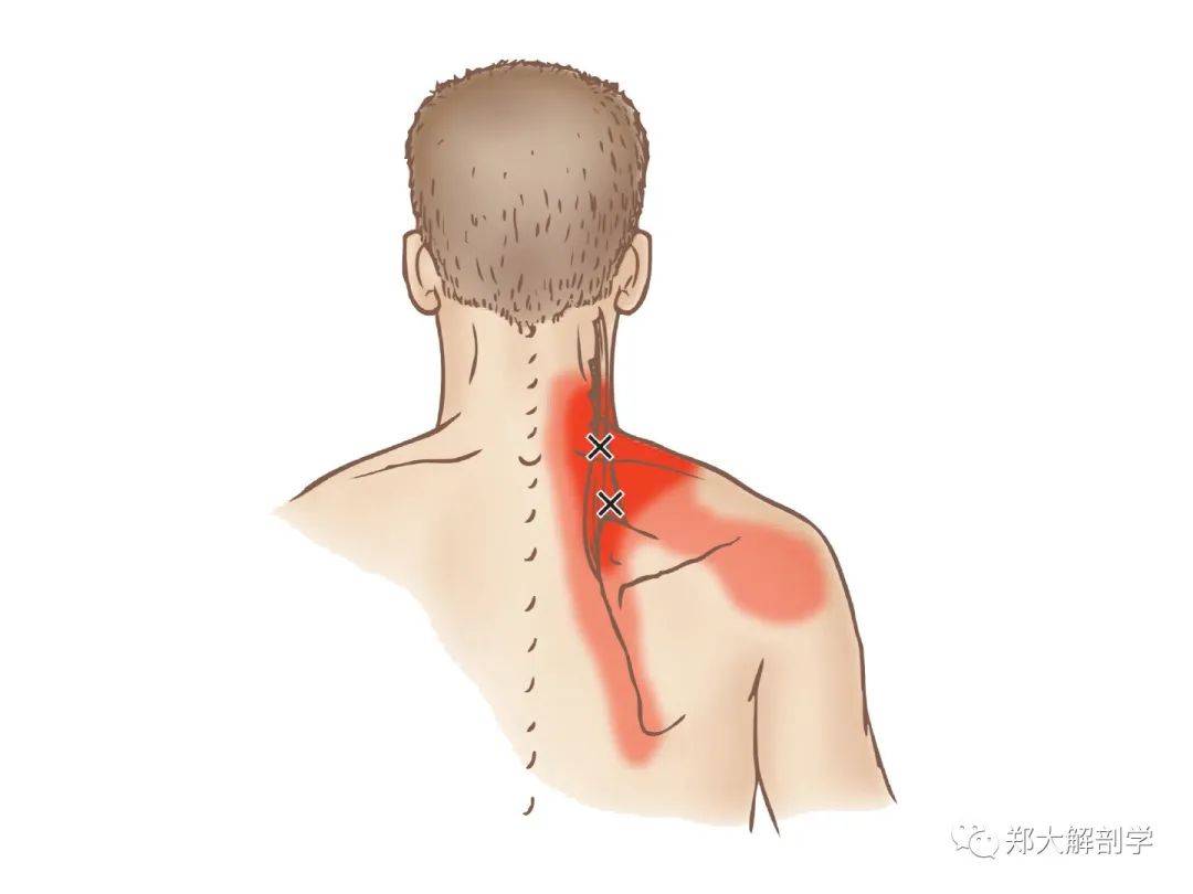 肩胛提肌扳机点图片