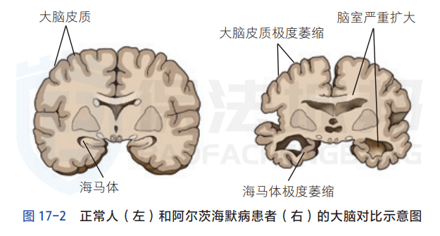 世界阿尔茨海默病日:ad的发病原理及预防原则_记忆_大脑_患者