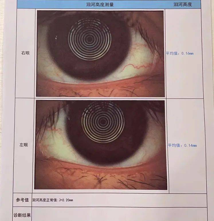 泪河变窄,断裂甚至消失的情况,泪河高度如果过低,有可能存在干眼症