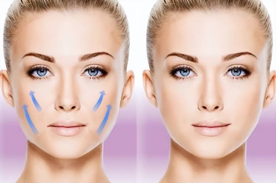 爱美宝典!面部筋膜提升,面部筋膜提升术能保持多久_皮肤_手术_损伤