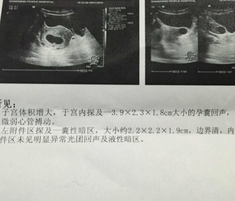 b超单有这3个孕检"数据", 可能将要生下"小王子",不妨一看_胎儿_性别