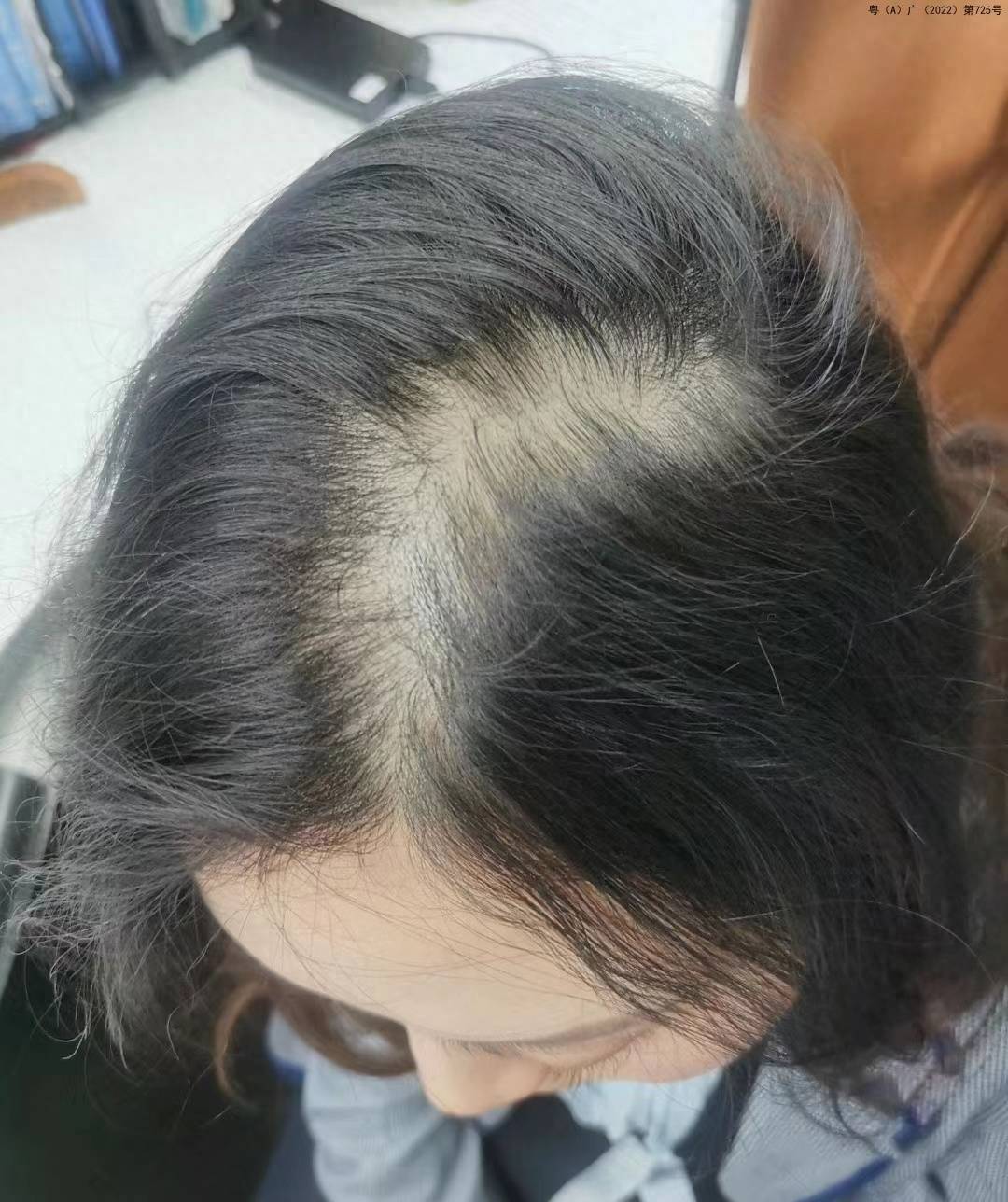 眼看自己真要变成秃子了,我是万般无奈下去了医院.