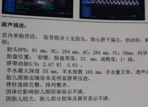 b超单有这3个孕检"数据", 可能将要生下"小王子",不妨一看_胎儿_性别