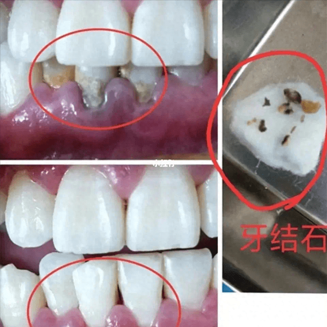 自律两个月!牙石直接成片脱落!_牙齿_牙粉_方法