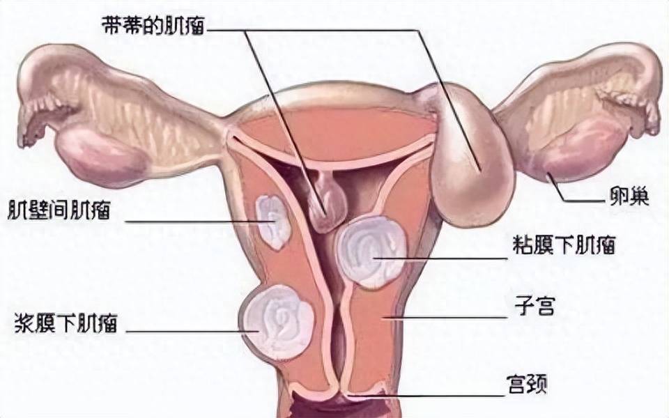 子宫肌瘤的症状有什么反映(附发病原因、如何治疗和预防)