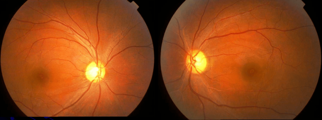 控制_眼底_血压高