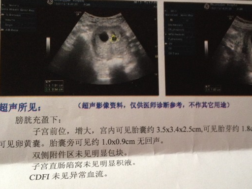 早孕b超单图片 报告单图片