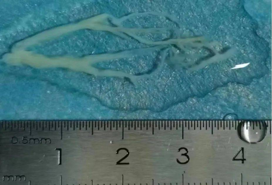 而在术中医生发现大量浓稠的分泌物把气管腔堵得死死的,吸也吸不动