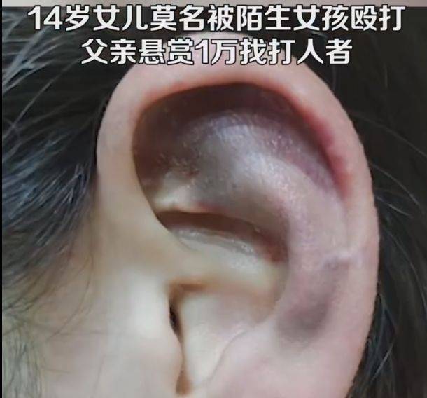 14岁女儿遭陌生女孩殴打,父亲悬赏1万找打人者,网友广泛支持_保护