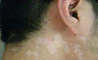 一个小偏方轻松去汗斑_皮肤_家人_斑点