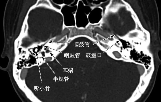 骨迷路成骨不全症:人在出生時骨迷路包囊已發育完成,唯獨在前庭窗邊緣