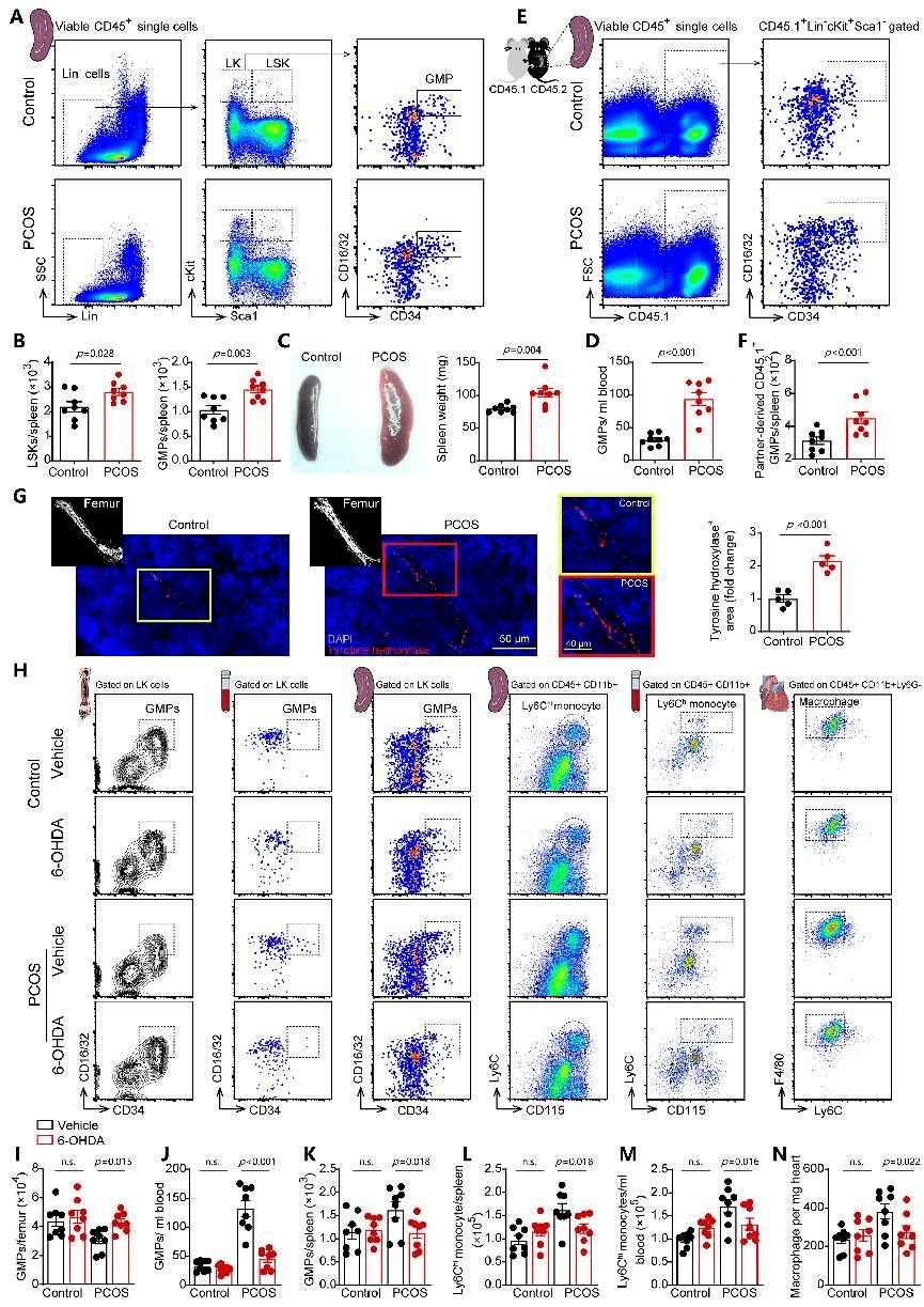 多囊卵巢综合征患者存在血浆去甲肾上腺素水平和循环炎症细胞(总单核