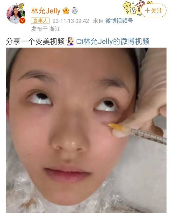 星女郎林允大胆公开打水光针过程，网友：为炒作太拼太狠 