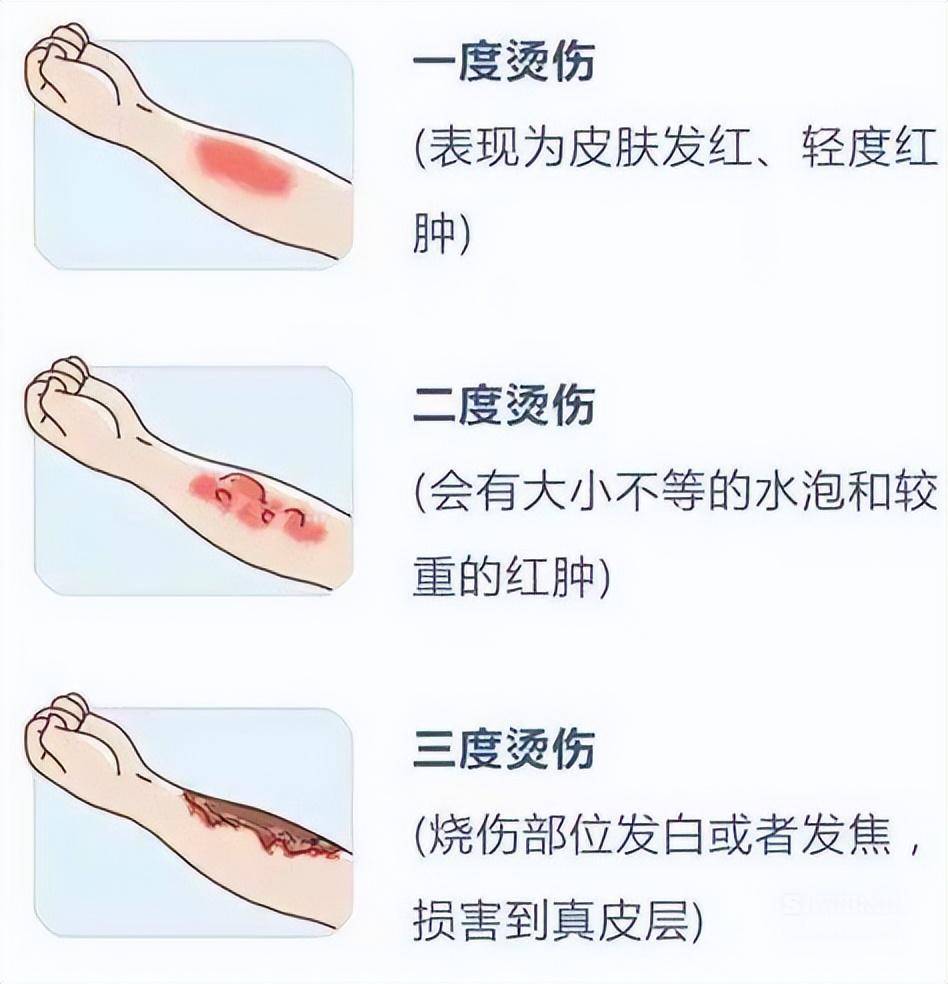 烫伤后如何防止疤痕形成?只需要记住这一招,别再花冤枉钱了!