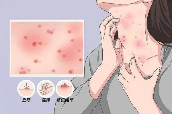 疥虫_皮肤_消毒