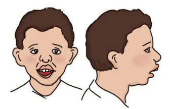 耳部症状病理性的腺样体肥大会导致孩子咽鼓管咽口受阻,引起分泌性