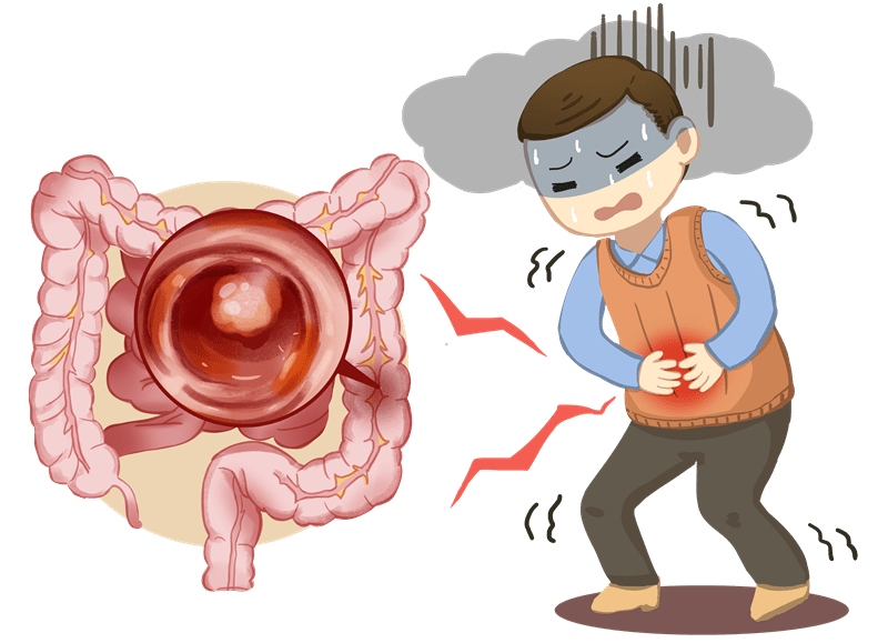 结肠癌早期的5大症状图片