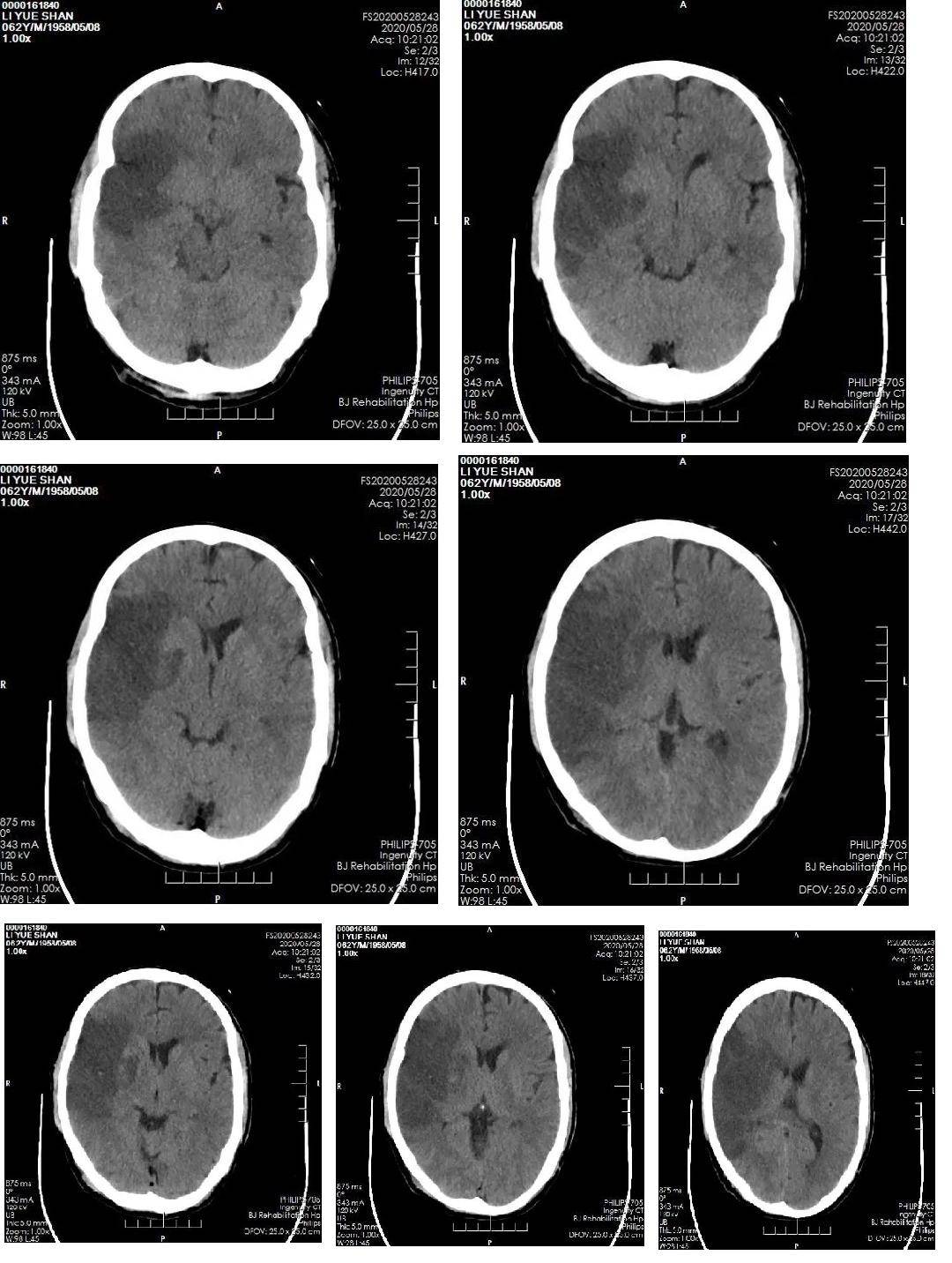 脑梗ct片子图片