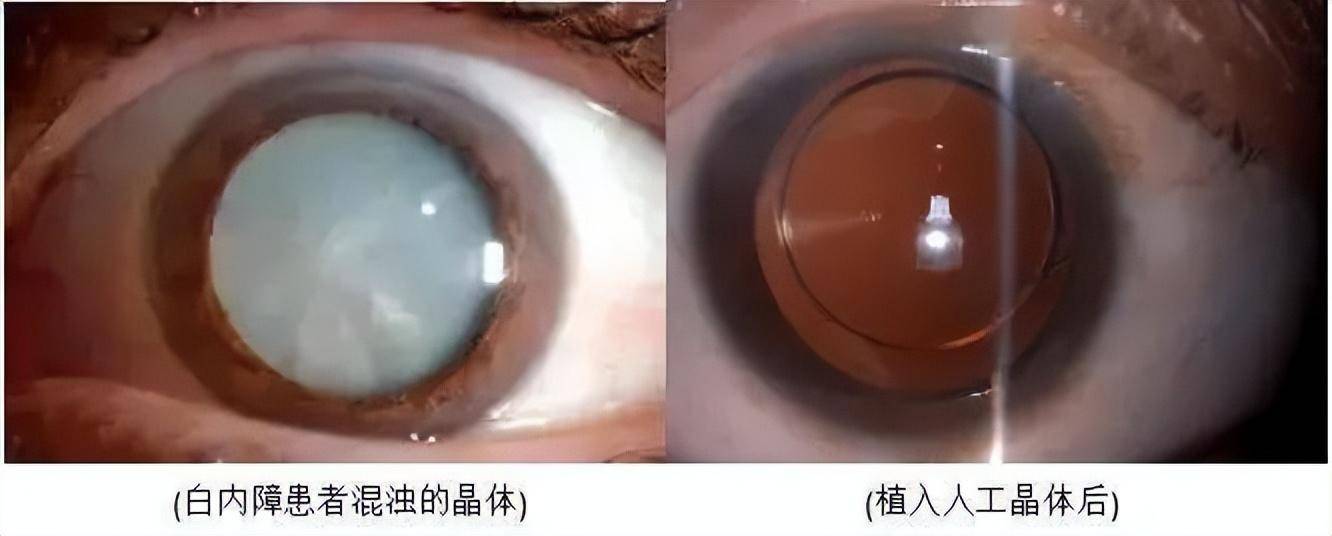 2什么是超声乳化人工晶体植入术超声乳化人工晶体植入术就是在黑眼珠