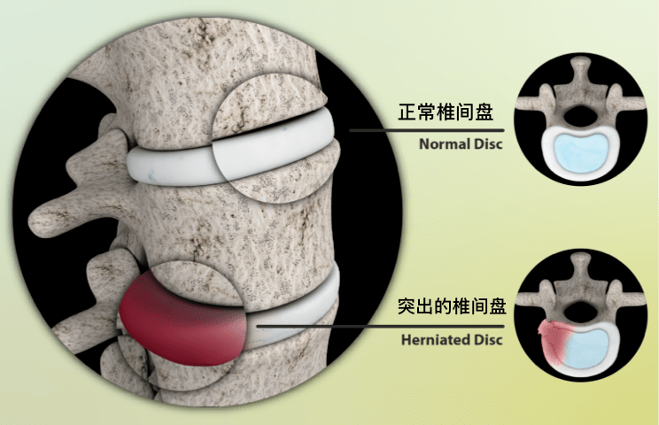 突出的_脊柱_腰部