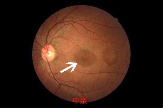 "中浆"也被形象比喻为"漏水".