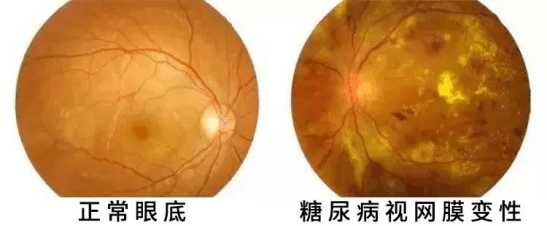 糖尿病视网膜病变又称糖网，是一种能导致视力缺失甚至失明的眼病。它的发病率很高