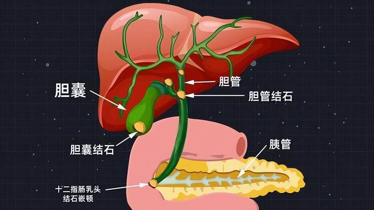 因此切除膽囊對身體仍有一定影響,如果相關病情不嚴重,其實可以選擇