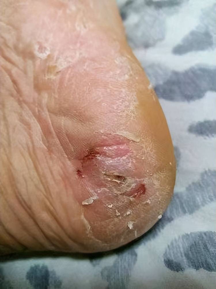 脚后跟干裂自用方法分享!根本不用瞎折腾!直接省下好几千!