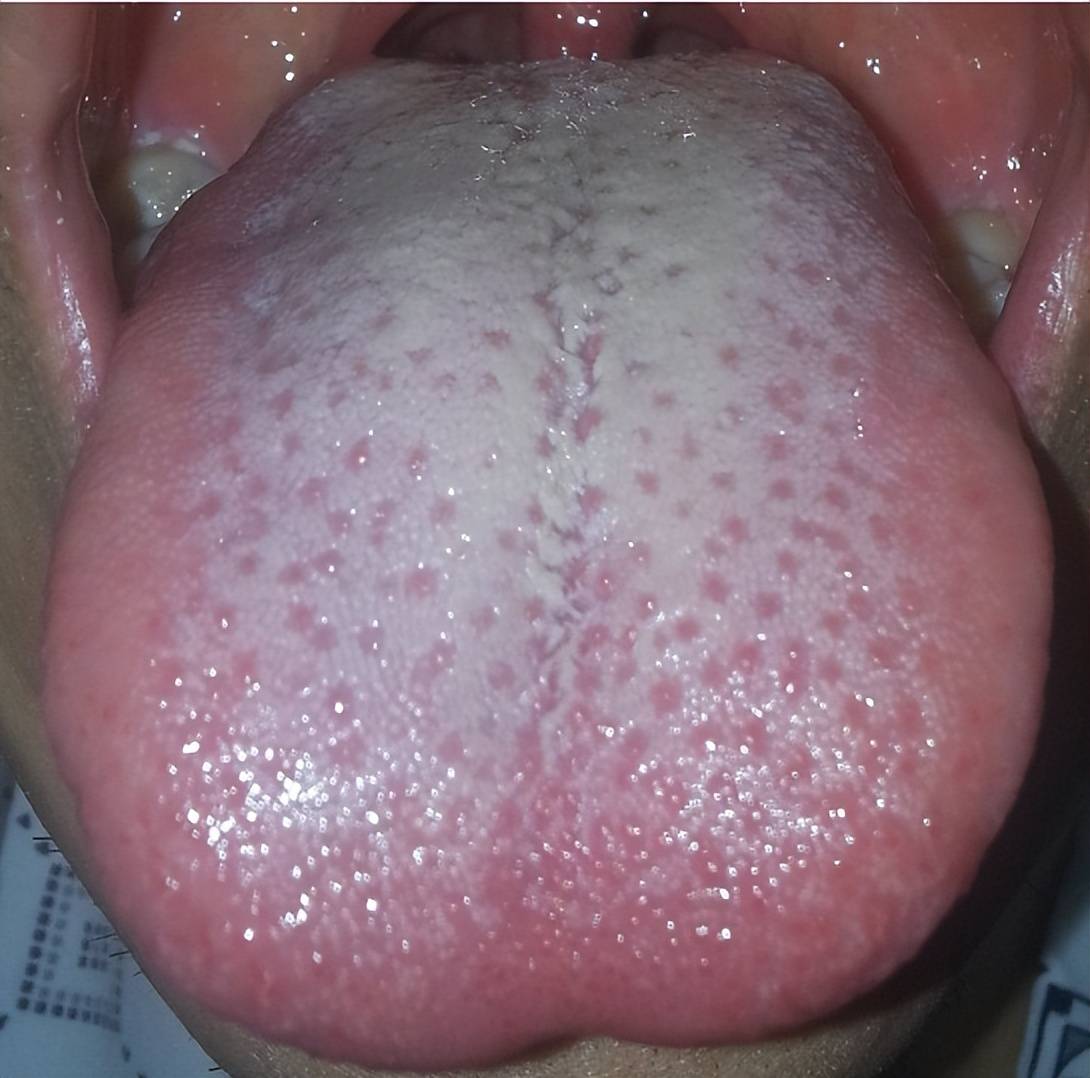 肾脏好不好看舌苔就能知道?你不信?那是你不了解中医_舌头_颜色_表面