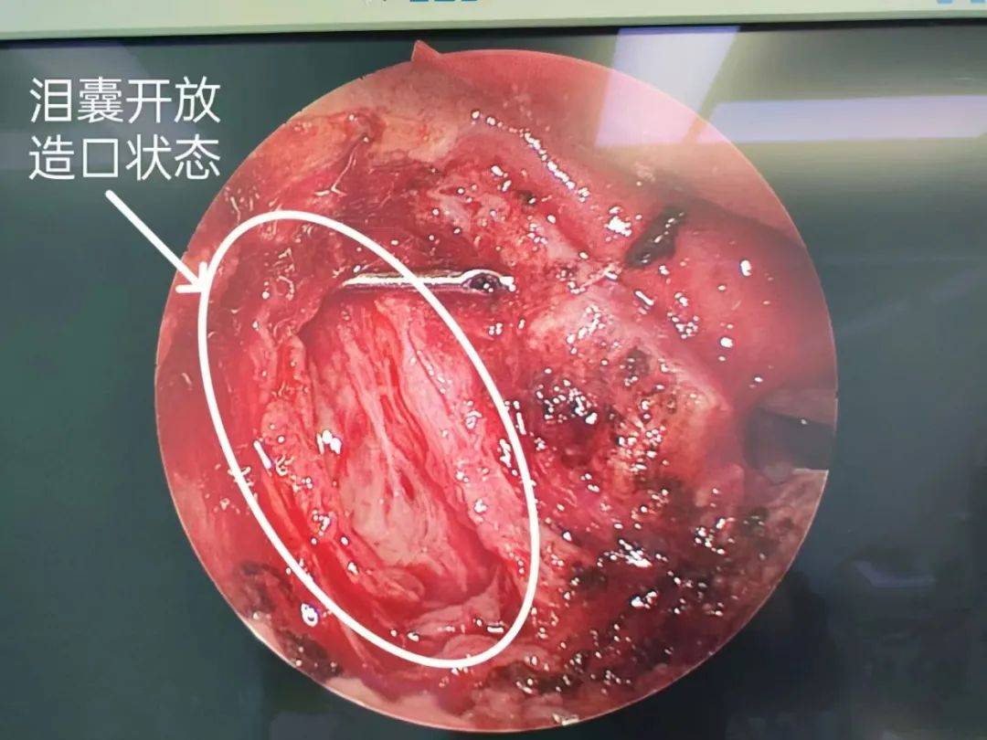 神奇!眼科疾患,竟然从鼻腔解决_手术_治疗_进行