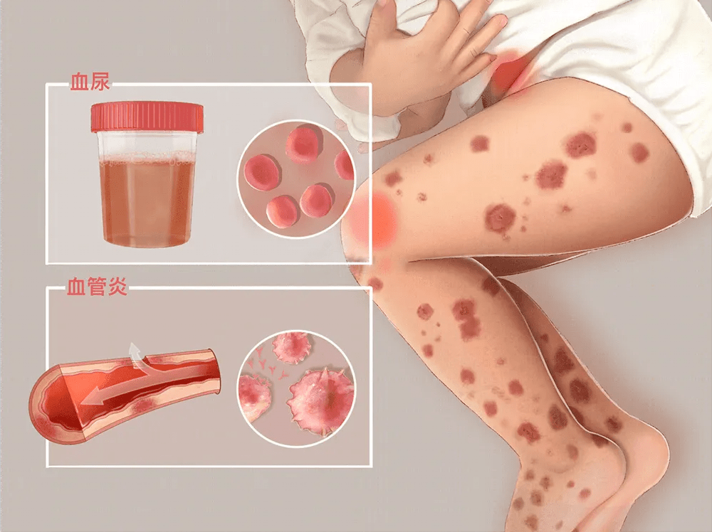 胡椒粉等辛辣调味料含有辣椒素,这些物质可能刺激皮肤和黏膜,导致过敏