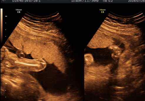 怀孕12周b超图男女图片