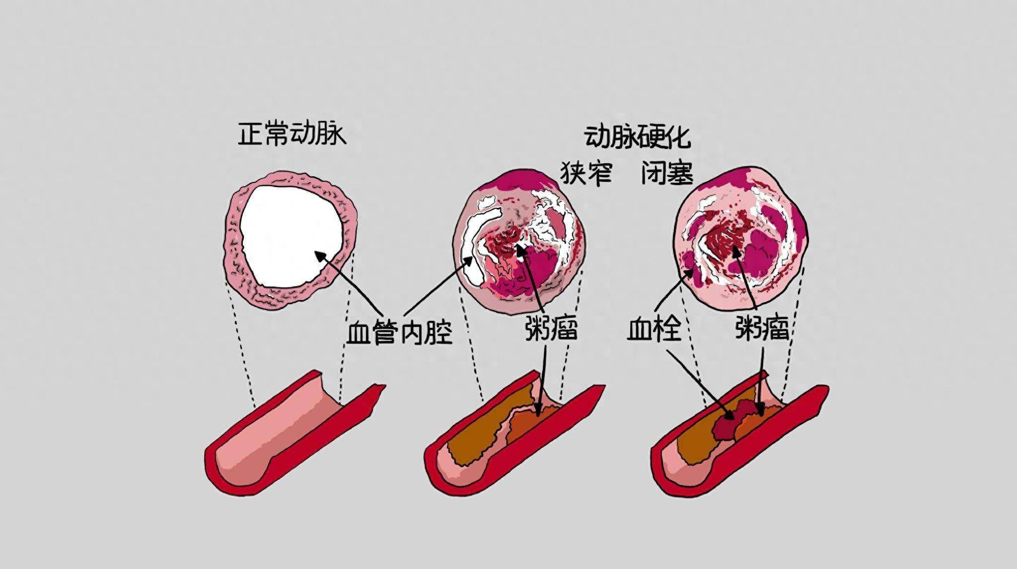 这7个危险因素要注意!_检查_斑块_影响