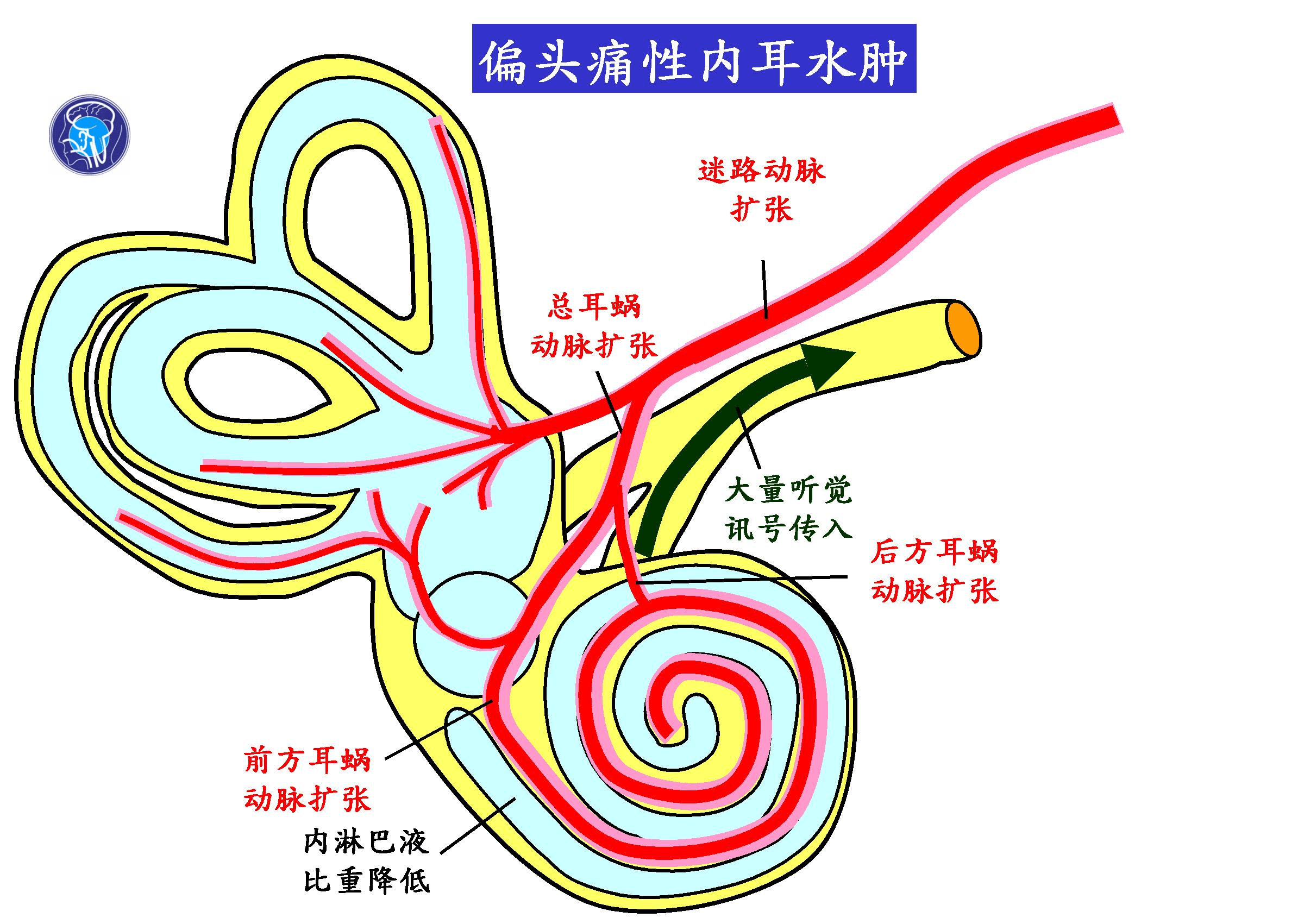 迷路动脉栓塞图片