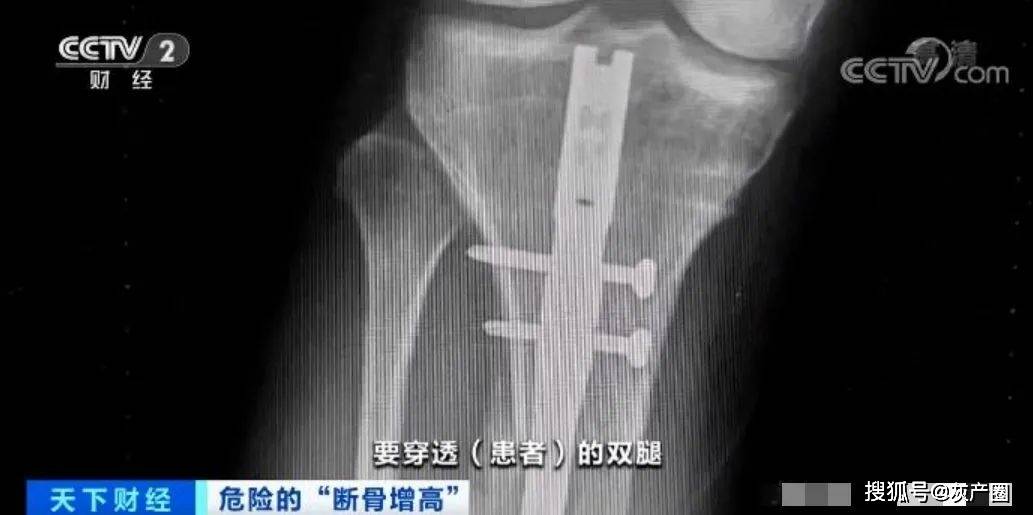 小嬌妻為滿足丈夫怪癖,斷骨增高……_雙腿_手術_網友