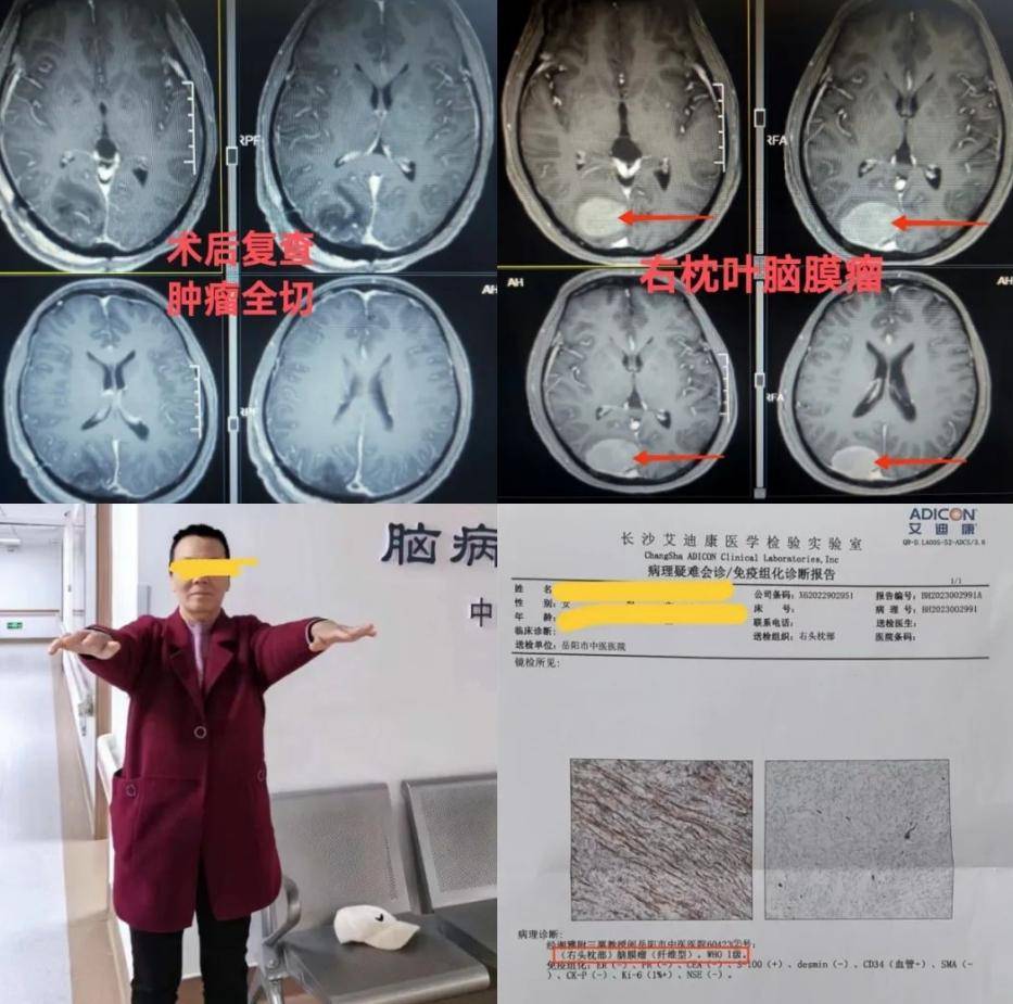 早在7年前因頭部外傷ct檢查,當時就發現右頂枕葉有個佔位病灶,考慮