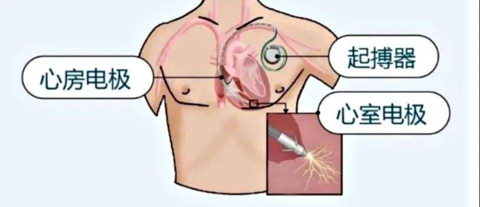無導線起搏器:病態竇房結的心跳修復魔法_臨床_患者_綜合徵