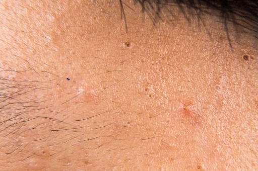 当"梅毒"藏在身体中时,或许会发现4个"信号",莫忽视!