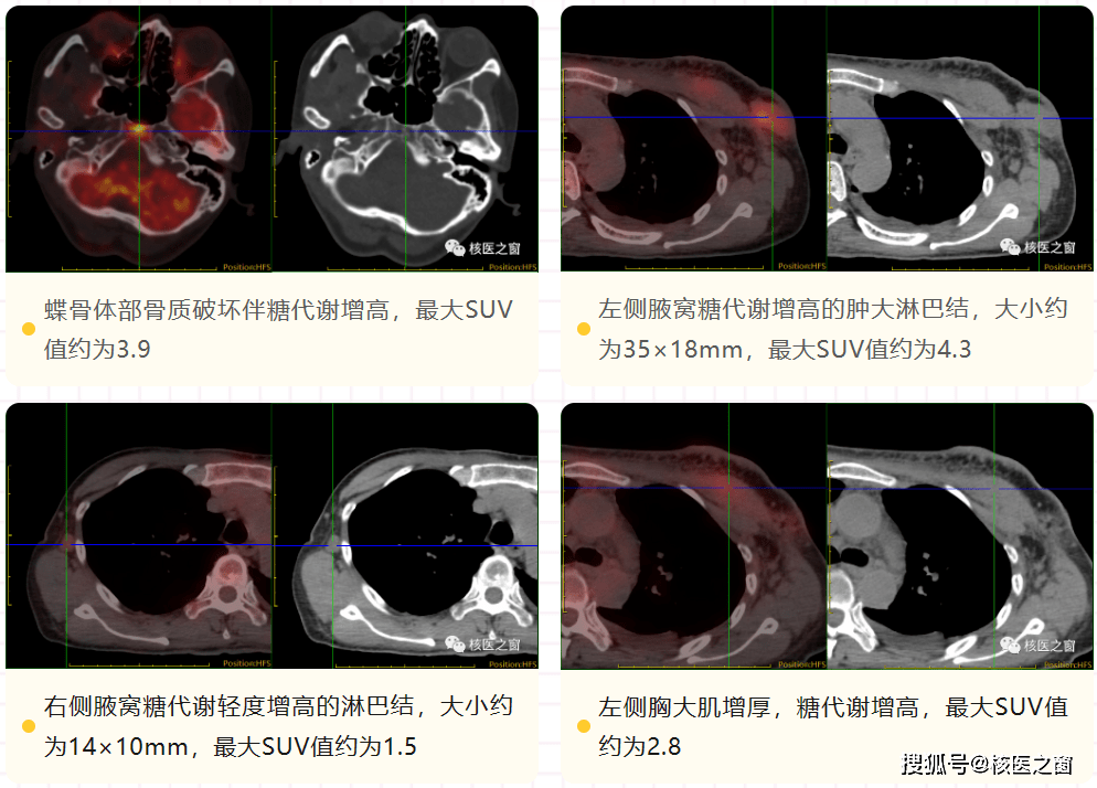 右乳多發不規則實性佔位,右乳餘實性結節,右乳囊腫,左側腋窩及鎖骨下