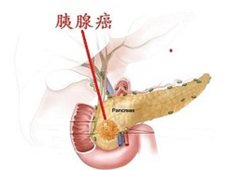 02膽囊及膽管疾病:如膽囊結石,膽囊息肉,膽囊炎變,膽管結石,膽囊癌與