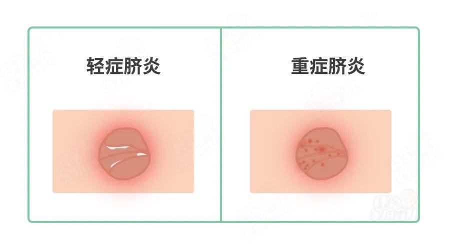 孩子肚子疼脐贴有用吗